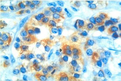 Figure 1. Histological section of IDC showed immunopositivity for Bcl-2 in the cytoplasm (magnification x400)